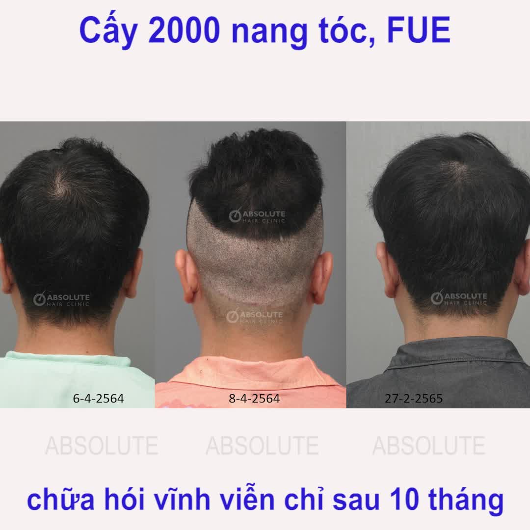 Dịch vụ cấy tóc tự thân tại Absolute Hair Clinic