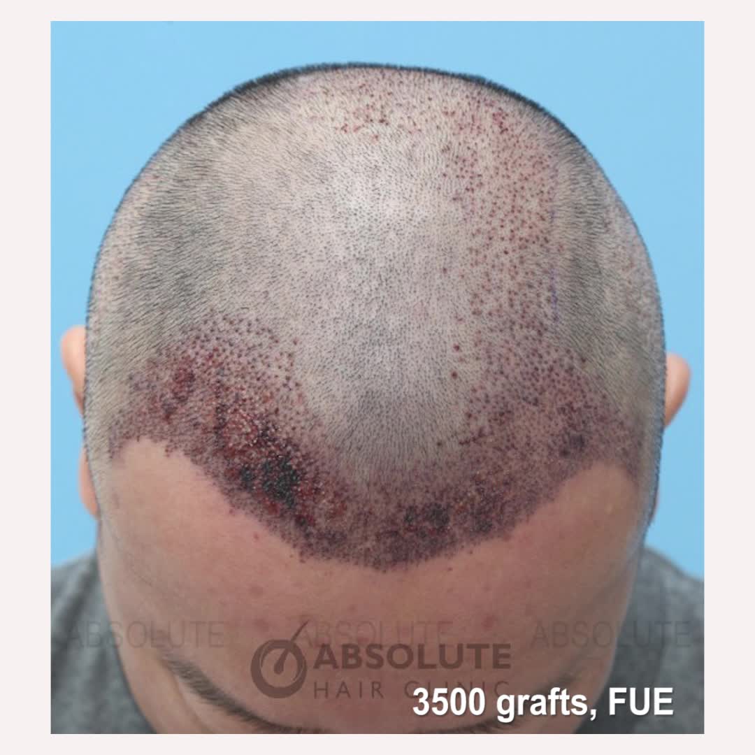 Cấy tóc tự thân 3500 nang - Absolute Hair
