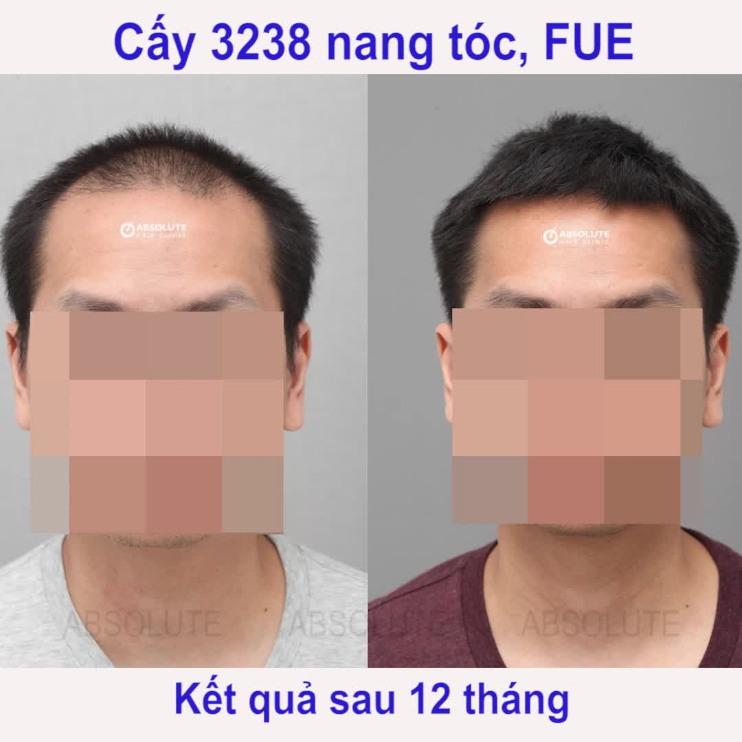 Cấy tóc Absolute - đã cấy là hết hói chữ M và hói đỉnh