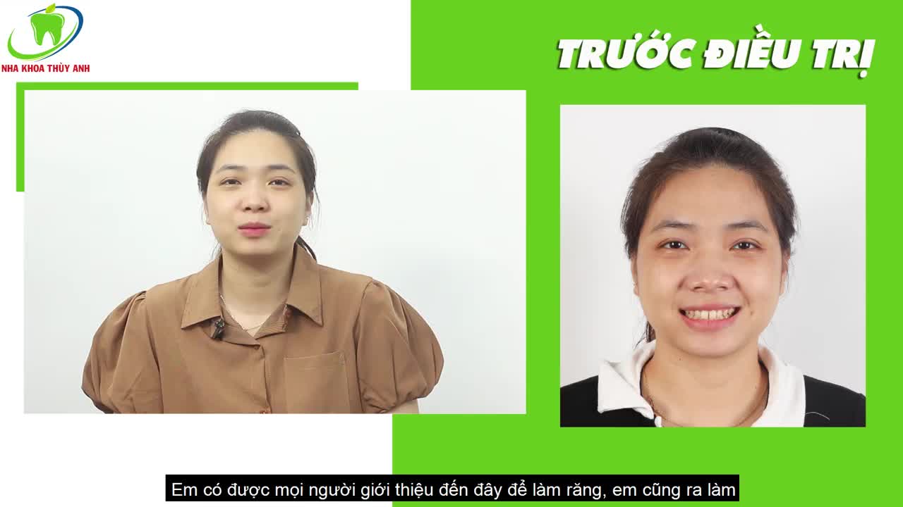 SỬA KHE THƯA RĂNG CỬA VỚI MẶT DÁN SỨ VENEER