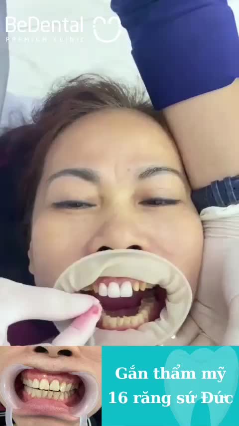 Vừa xong! Gắn răng thẩm mỹ cho khách hàng tại BeDental chi nhánh Thi Sách (HN)