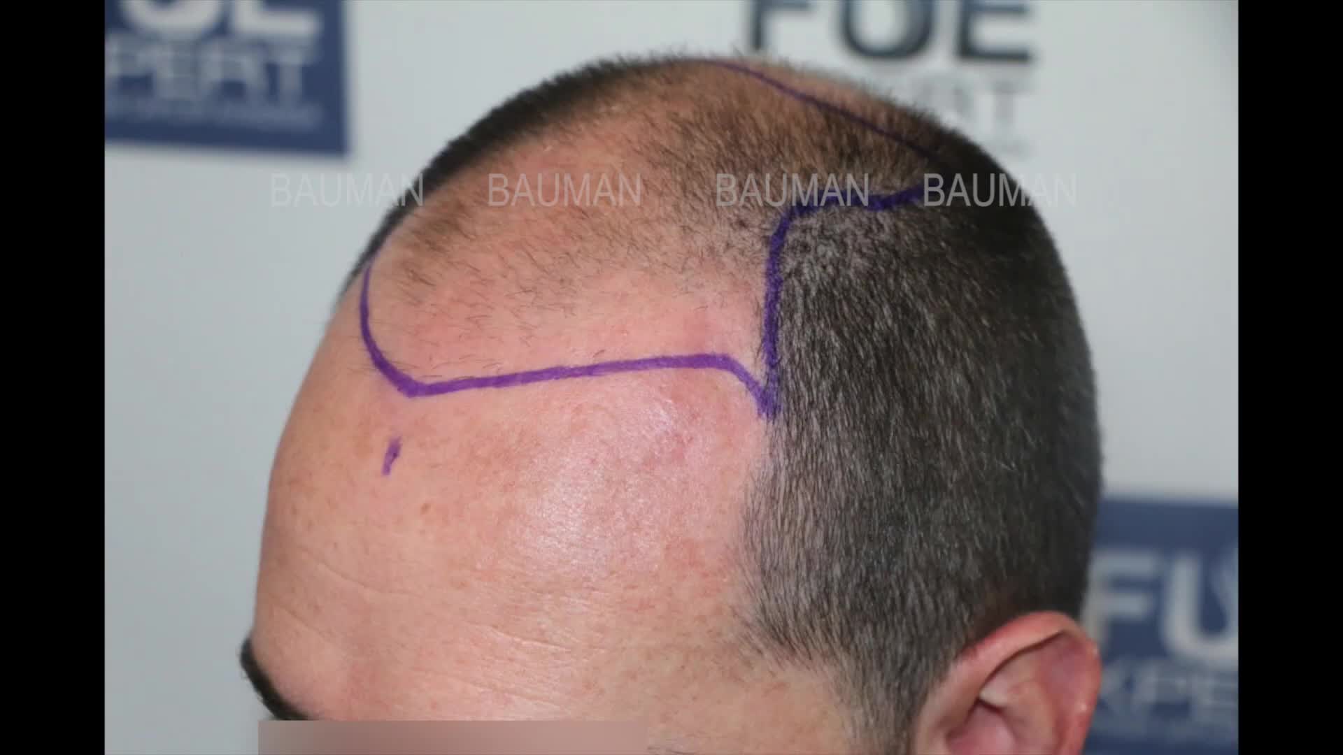 Cấy tóc tự thân 4766 nang tóc, kỹ thuật FUE