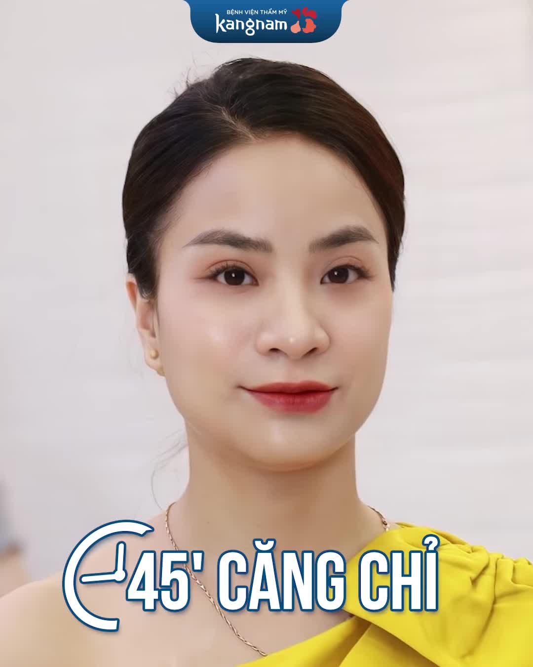 Căng chỉ để đẹp hơn, tự tin hạnh phúc hơn!