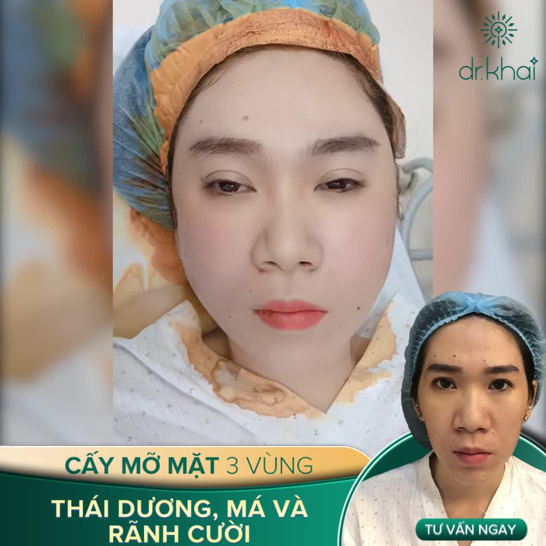 TRẢ KẾT QUẢ CA CẤY MỠ TOÀN MẶT 3 VÙNG THÁI DƯƠNG, RÃNH CƯỜI, MÁ