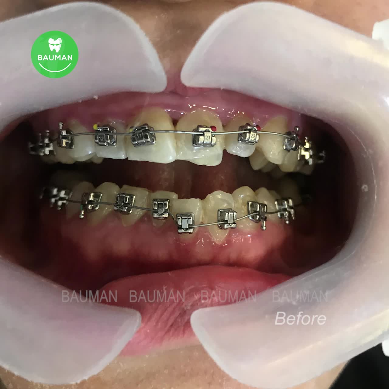 Ca niềng răng 5274 | Nha Khoa Bauman