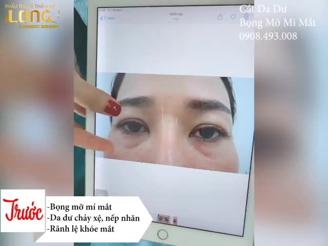 KHÁCH HÀNG SAU 30 PHÚT LẤY BỌNG MỠ MÍ DƯỚI