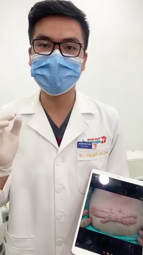 Sẹo lồi khổng lồ sau 1 liệu trình liệu có thay đổi