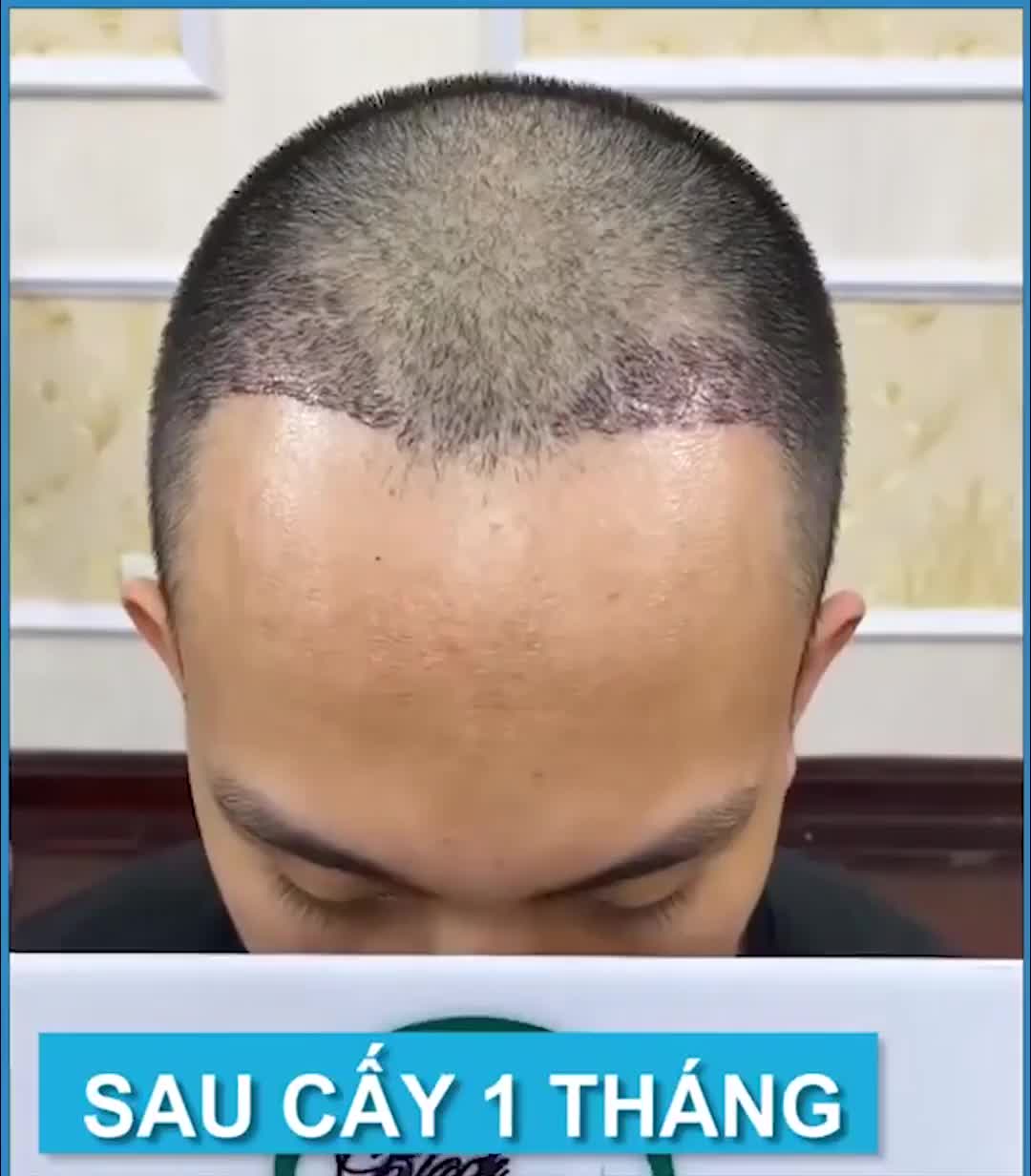 Cấy 1100 nang tóc trị hói chữ M cùng Dr Duy Thành