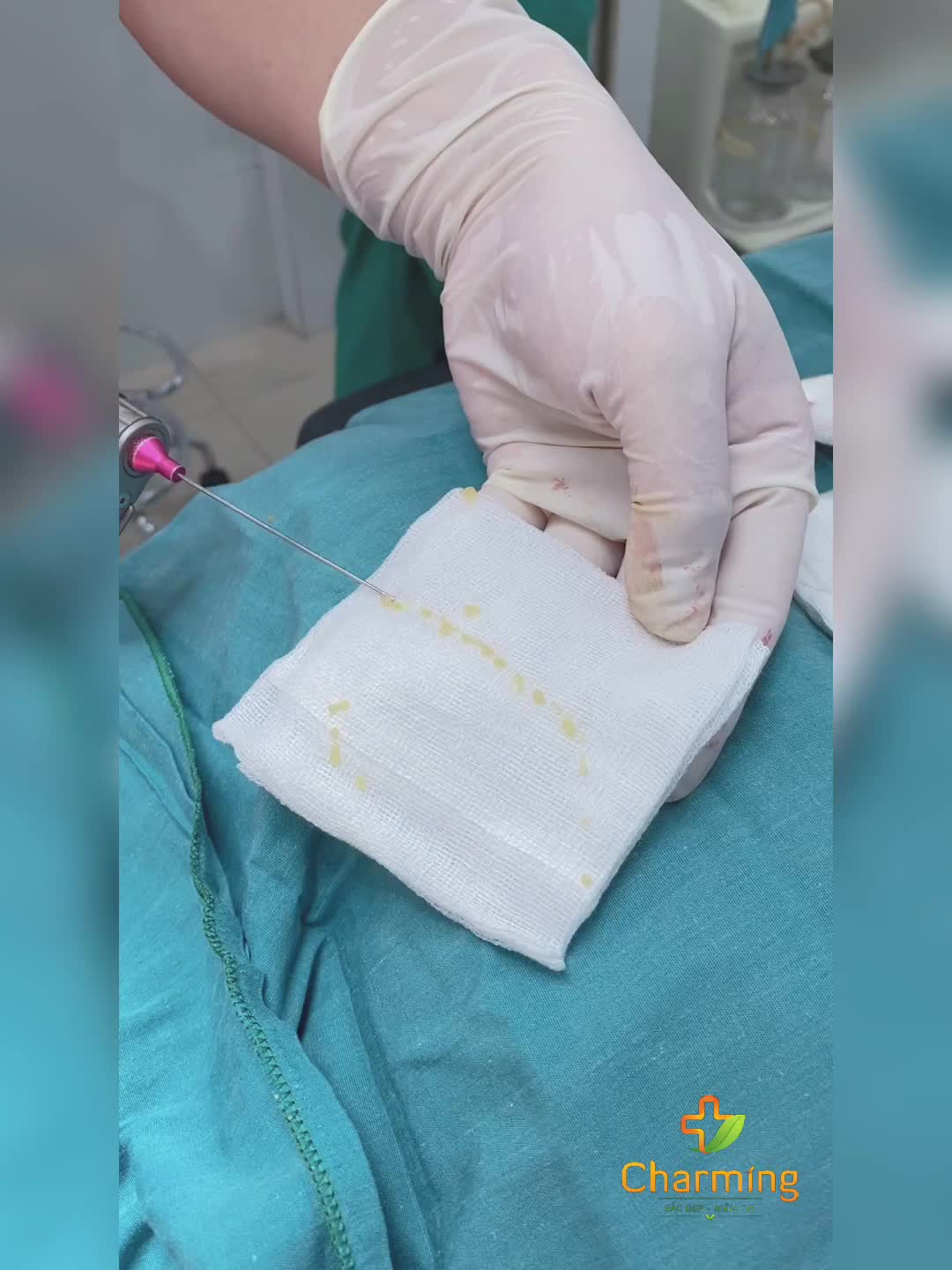CÓ NÊN LẤY MỠ MÍ TRÊN ĐỂ CẤY CHO MÍ DƯỚI