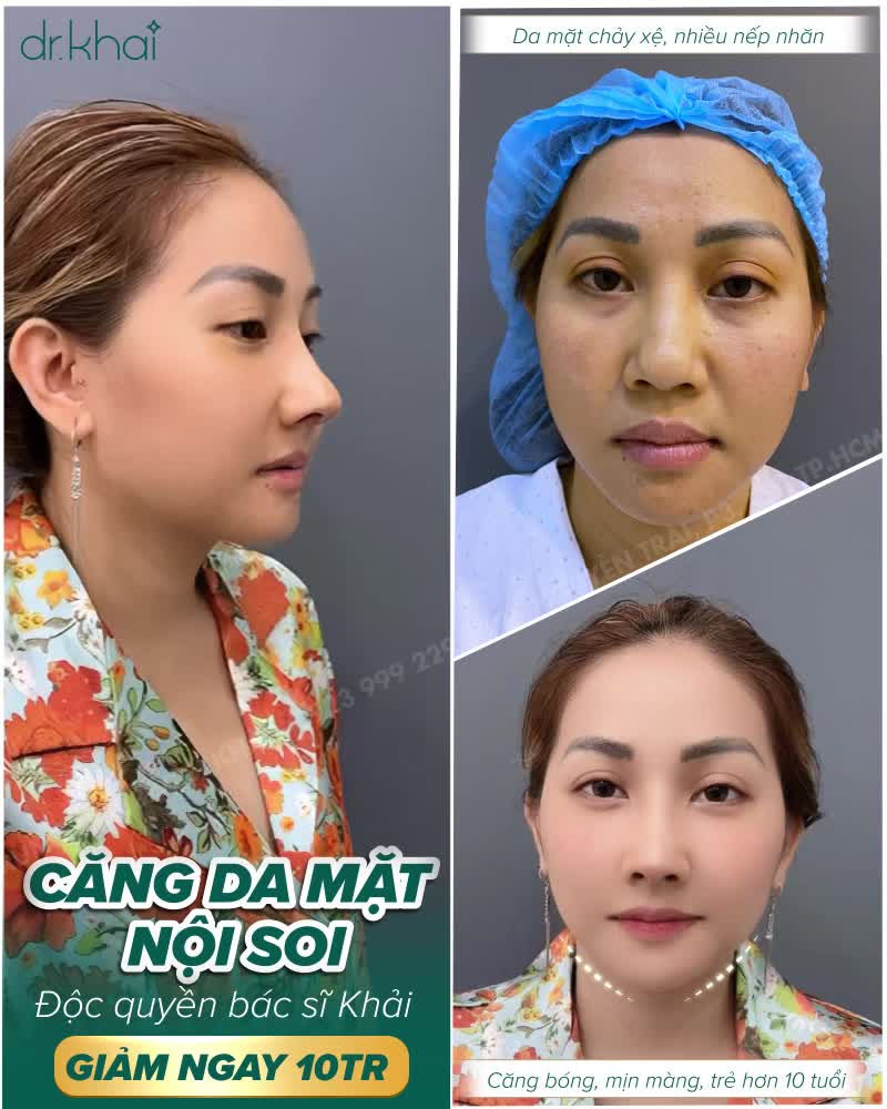 CĂNG DA MẶT NỘI SOI - 5 KHÔNG