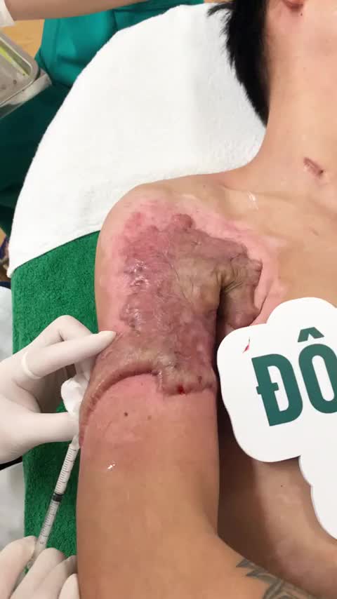 SẸO LỒI siêu to khổng lồ do BỎNG HÓA CHẤT!!!