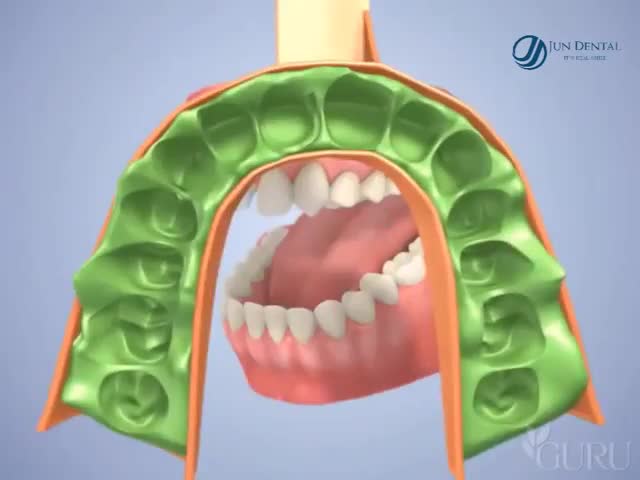 Một bước quan trọng trước khi dán sứ chính là bước Lấy dấu răng sứ.