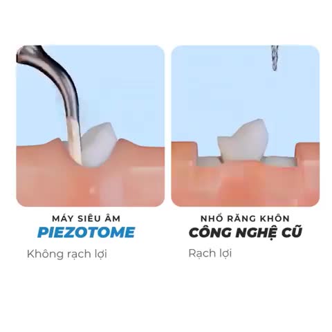 Răng Khôn Hết Đau - Chỉ Sau 5 Phút