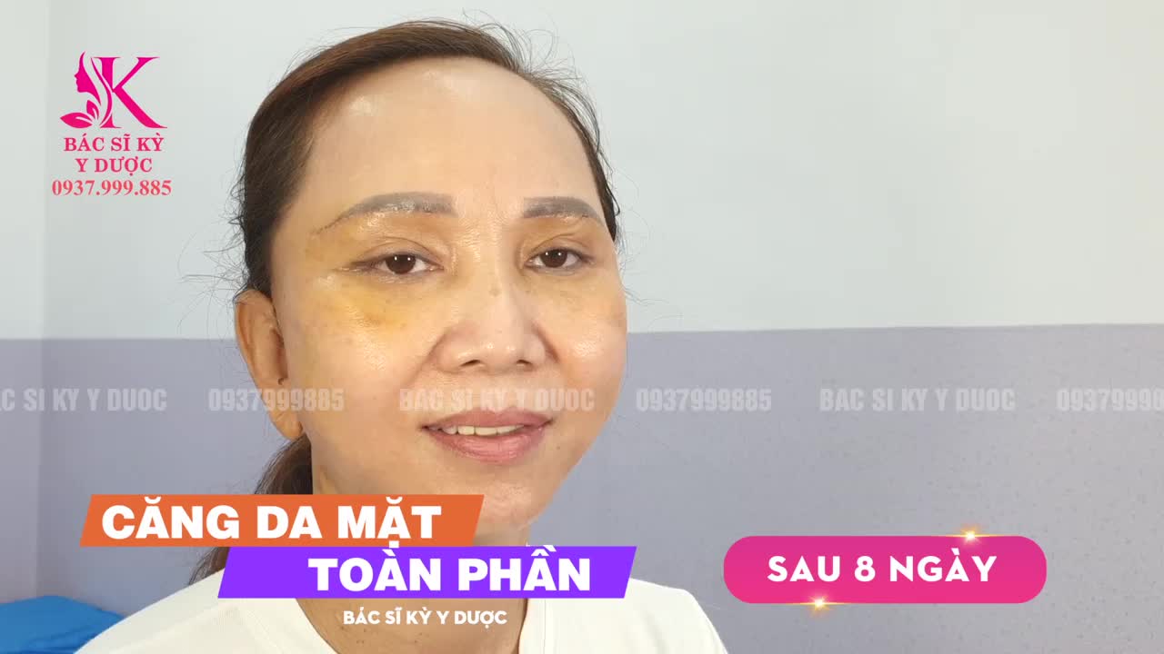 Trẻ Hơn 10 Tuổi Sau Khi Căng Da Mặt Toàn Phần - Bác sĩ Kỳ Y Dược