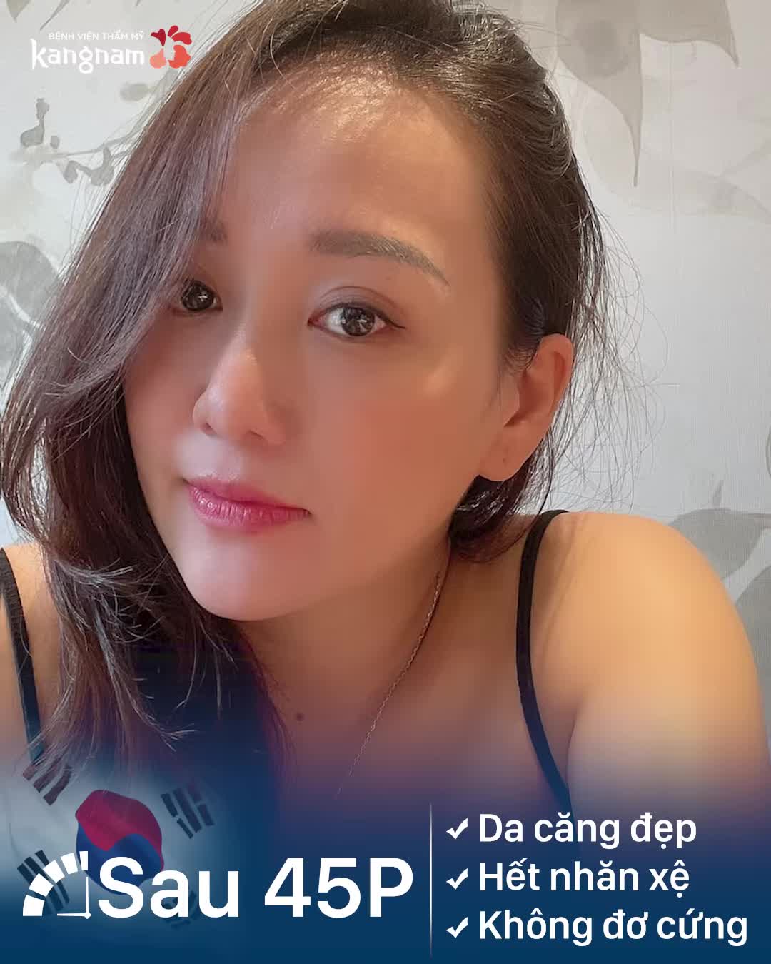 1 lần Căng chỉ, trẻ ra 10 tuổi là có thật!!