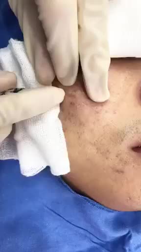 Khám phá quy trình trị sẹo lõm sẹo rỗ bằng cấy da siêu vi điểm