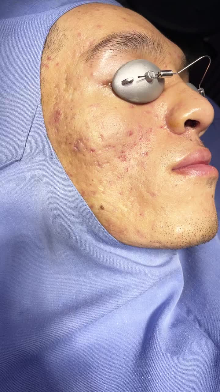 Công nghệ điều trị sẹo lõm Scarnano cực kỳ hiệu quả