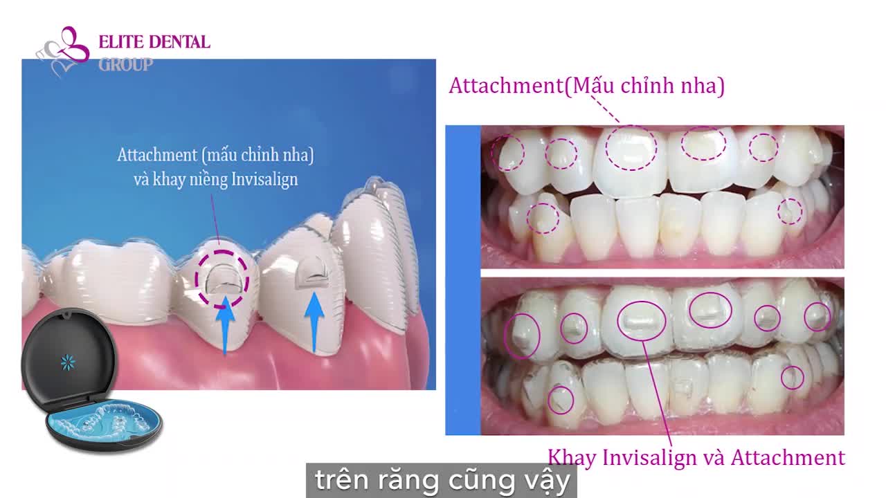 HƯỚNG DẪN MANG VÀ THÁO KHAY NIỀNG INVISALIGN