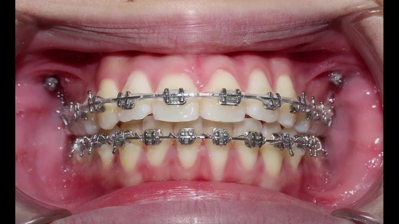 RĂNG MỌC LỆCH - KHÔNG ĐỀU