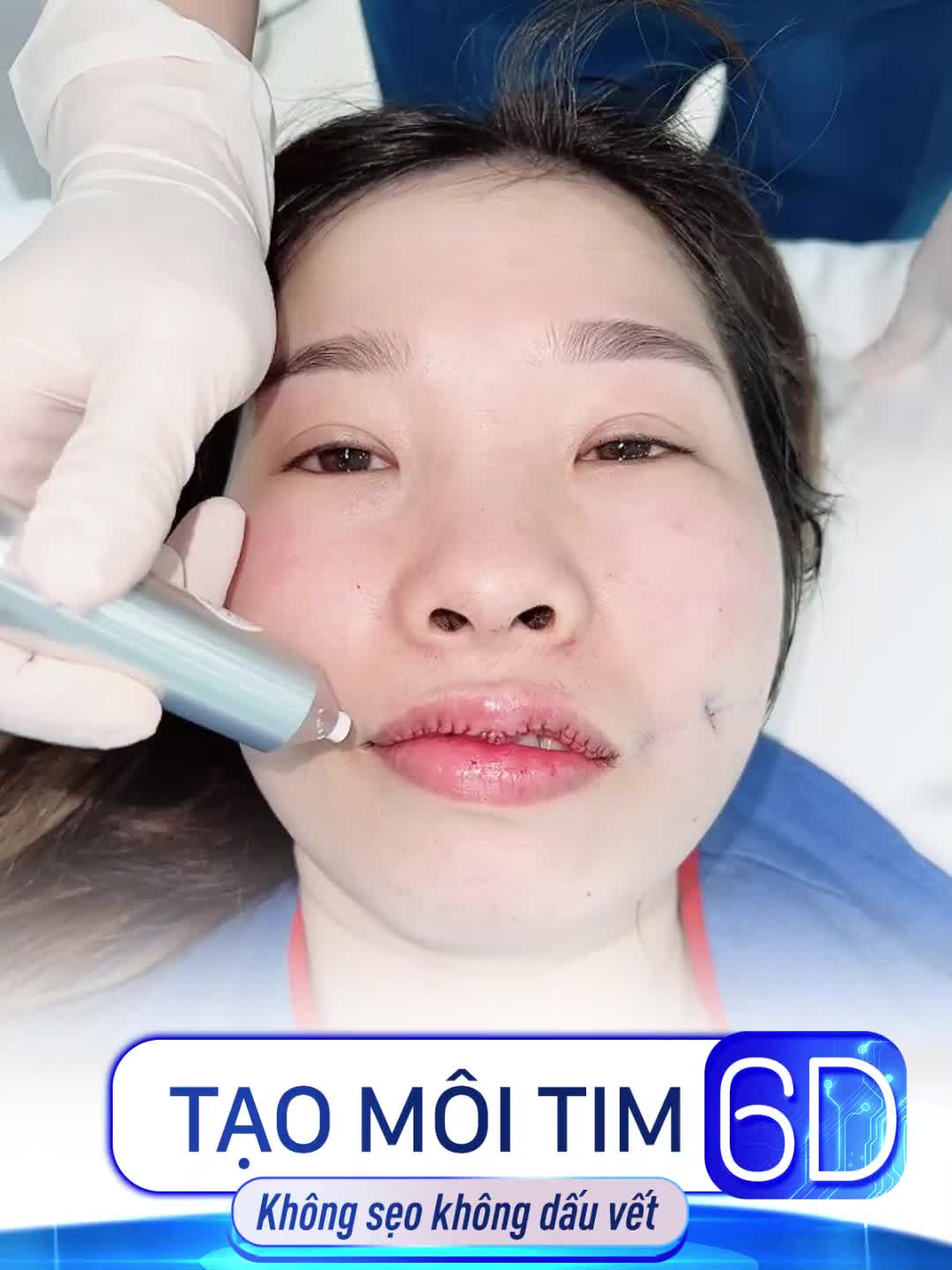 Hot!! Cận cảnh chiếu tia Plasma lạnh cho môi Tạo hình 6D