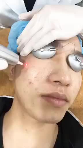 VẾT THÂM SẸO DO MỤN sẽ điều trị như thế nào