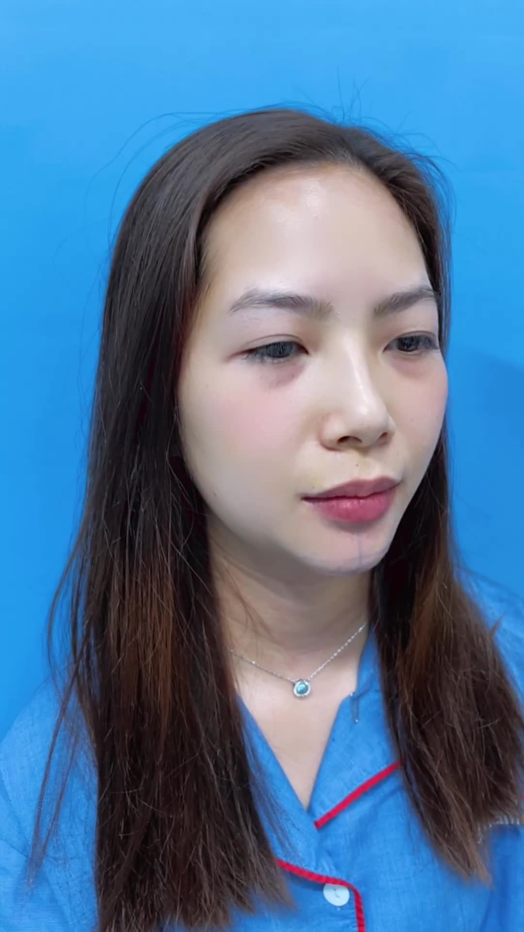 Không tới 1h đồng hồ - Sở hữu ngay gương mặt cân đối với chiếc cằm tỉ lệ vàng quá ưng ý