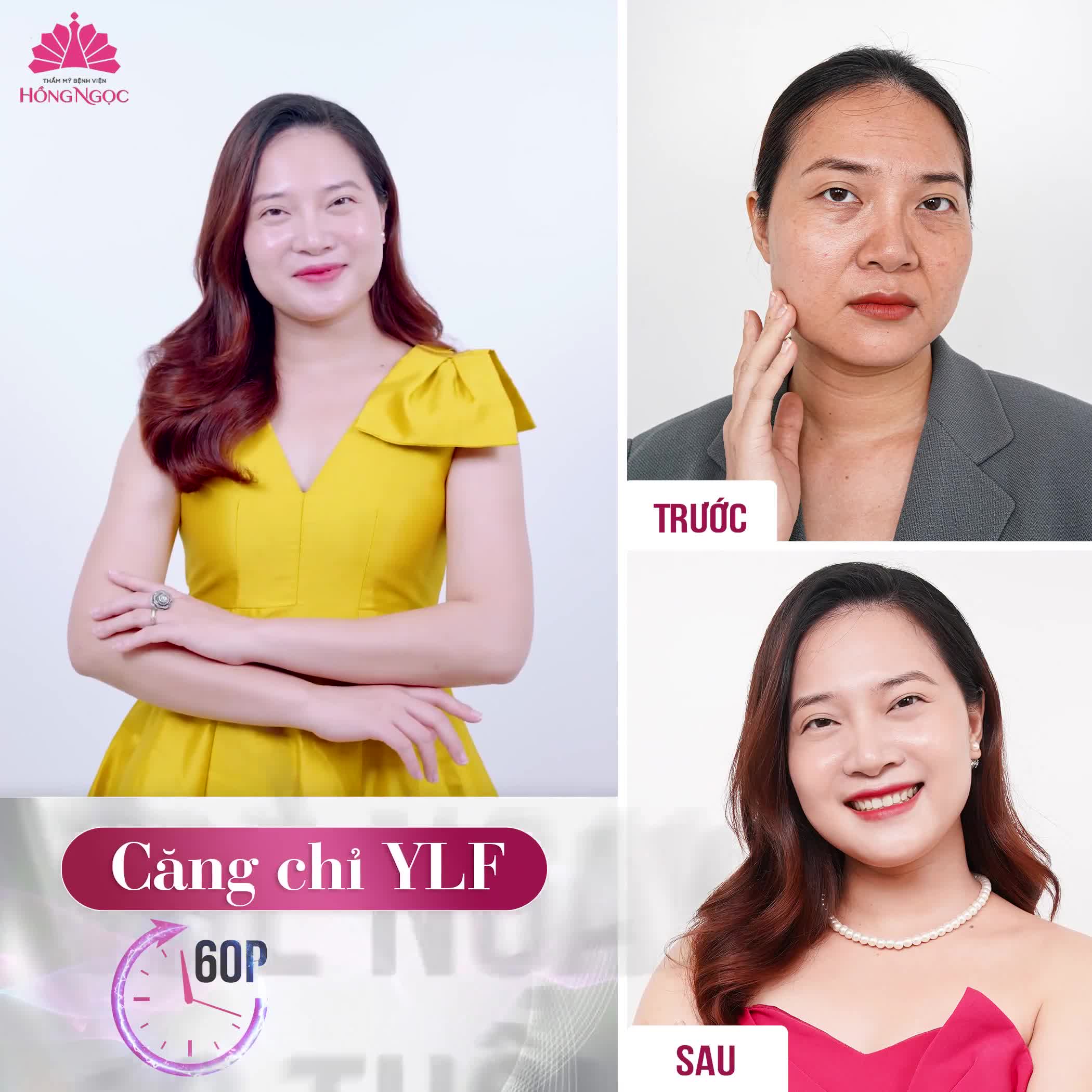 TRẺ TRUNG, MẶT ĐẦY ĐẶN PHÚC HẬU VỚI CÔNG NGHỆ CĂNG CHỈ YLF