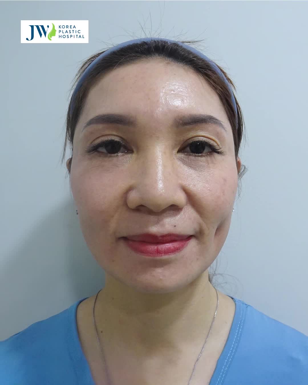 CẢI LÃO GƯƠNG MẶT 3M đưa QUÝ CÔ U40 trở về 10 NĂM TRƯỚC VƯỢT NGOÀI MONG ĐỢI