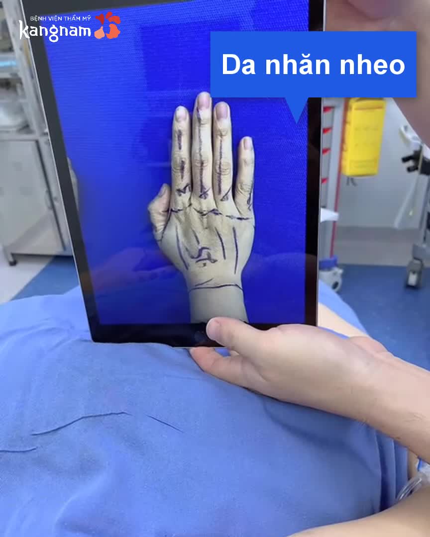 Trẻ hóa bàn tay bằng cấy mỡ - Tay đẹp, căng mịn tức thì
