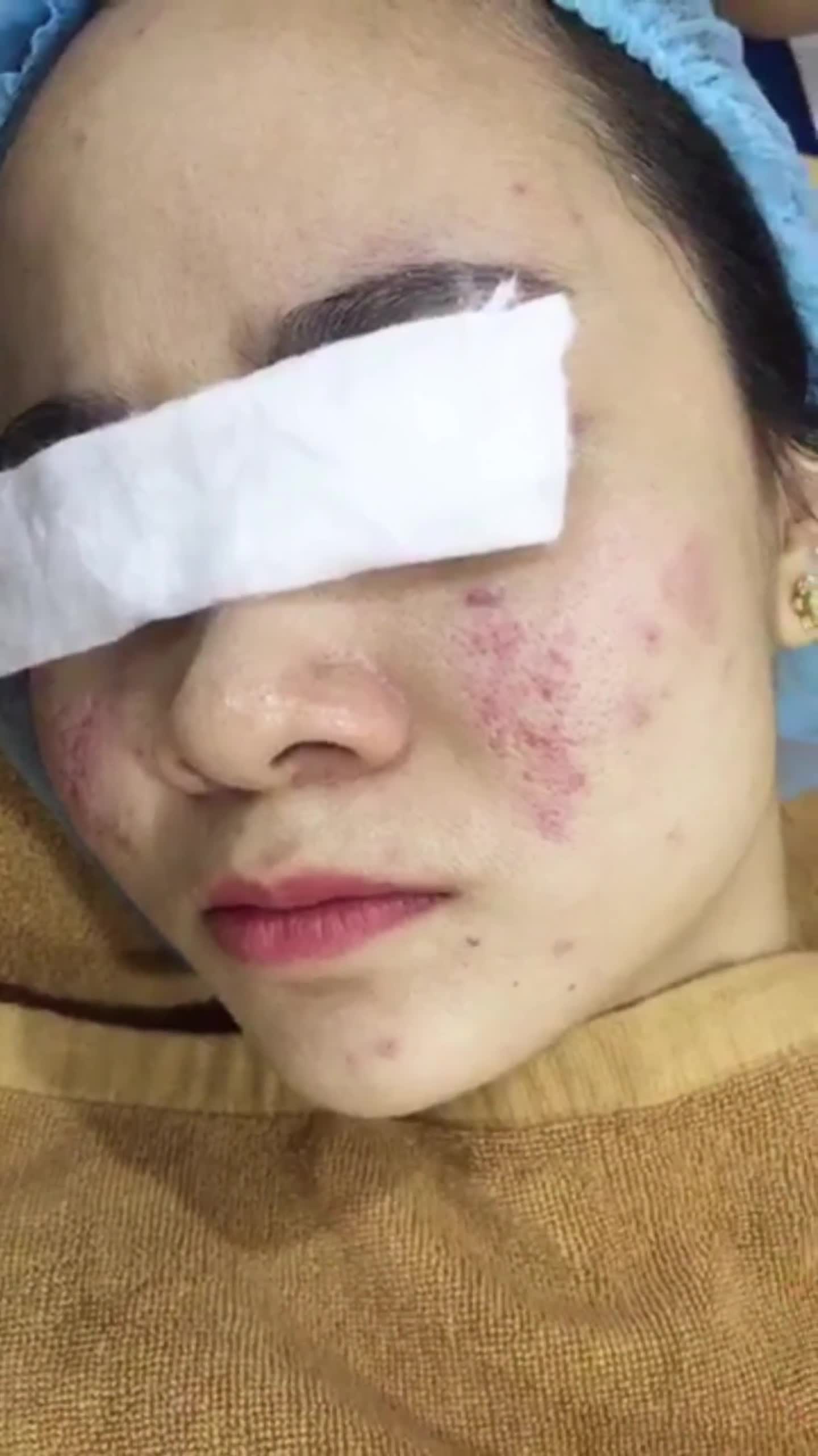 LASER FRACTIONAL - BƯỚC ĐỘT PHÁ TRONG ĐIỀU TRỊ SẸO RỖ