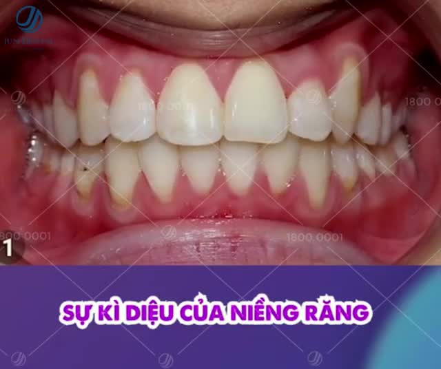 NIỀNG RĂNG ĐỘ TUỔI VÀNG
