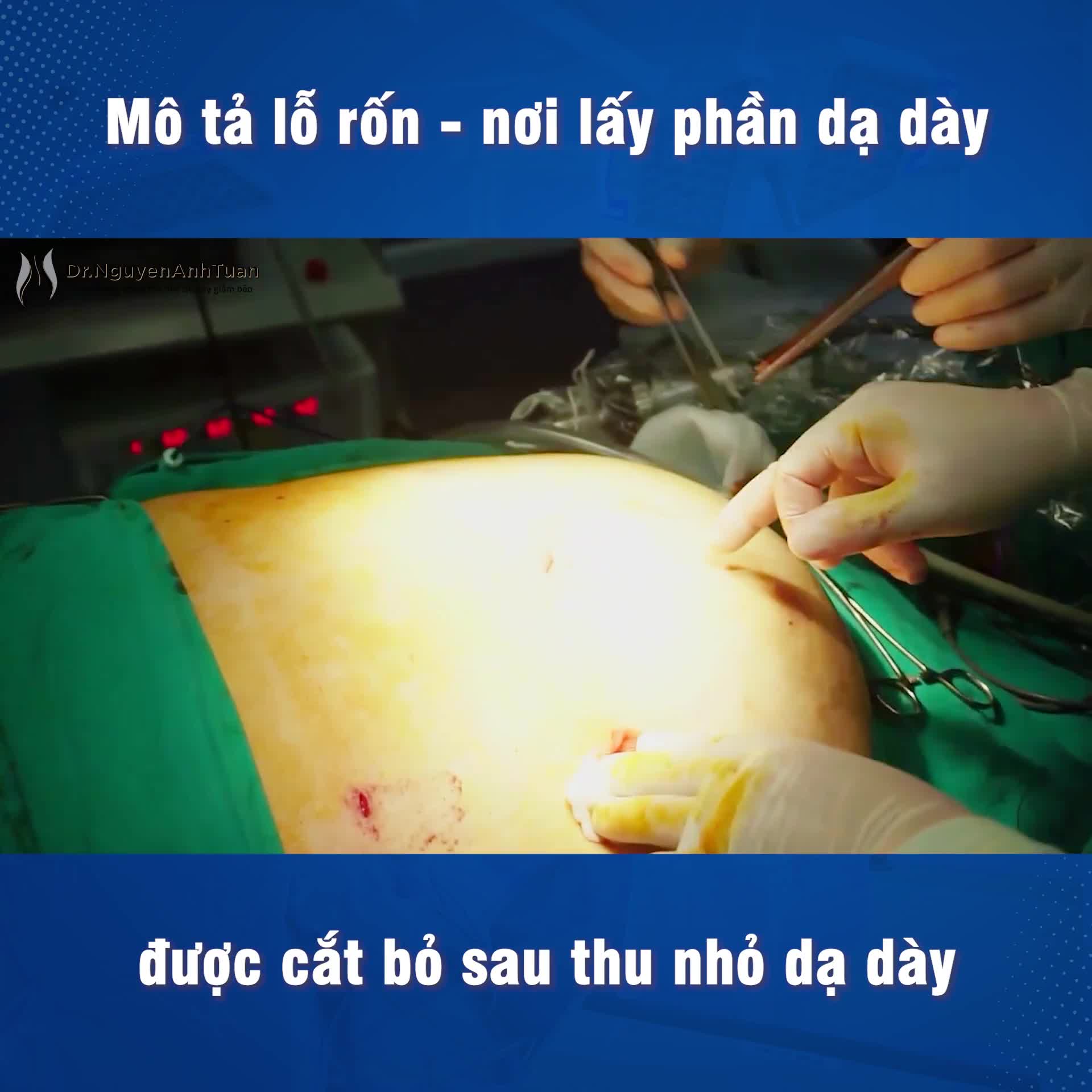Cận cảnh lỗ rốn - nơi đặt lỗ trocar lấy phần dạ dày được cắt bỏ ra khỏi ổ bụng của bệnh nhân béo phì.