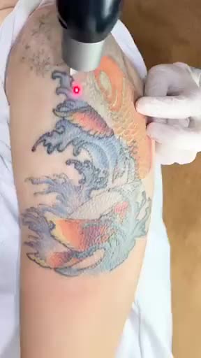 Xăm Xấu muốn xóa nhưng sợ sẹo, loang lổ