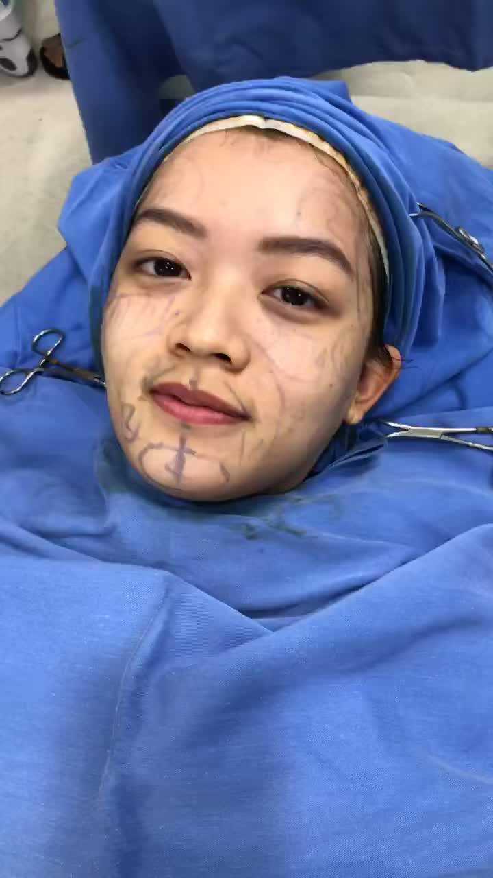 Phân tích trước khi cấy mỡ mặt