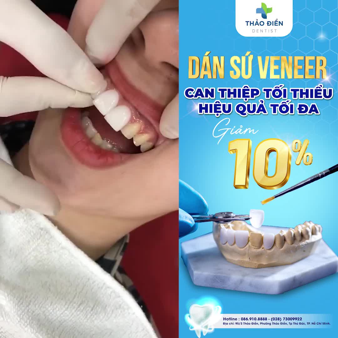 DÁN SỨ VENEER - CAN THIỆP TỐI THIỂU, HIỆU QUẢ TỐI ĐA GIẢM 10% CHỈ CÒN 6.300K