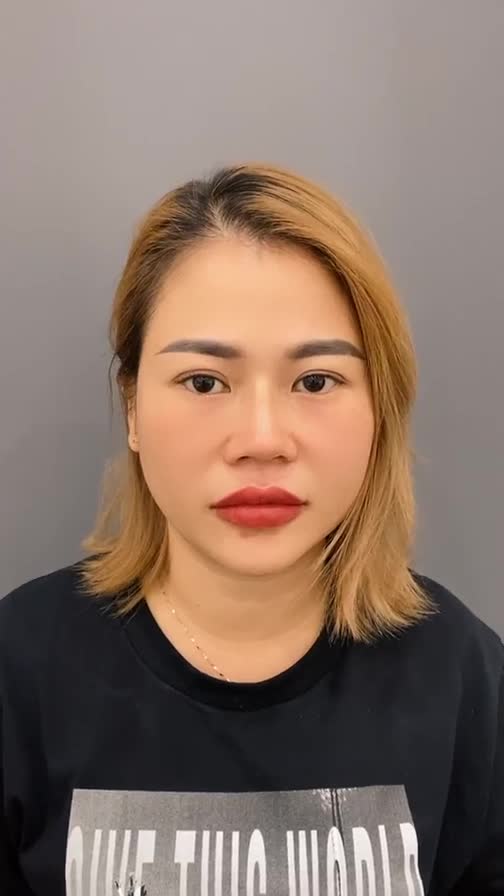 Ngắm kết quả Độn Cằm 8 tháng này lấy can đảm đi làm đẹp nha cả nhà