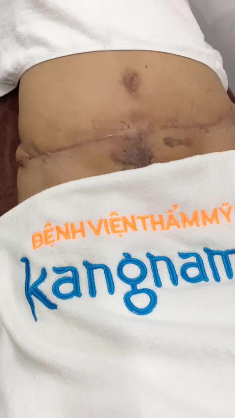Tai nạn hình thành nhiều sẹo lồi trên cơ thể