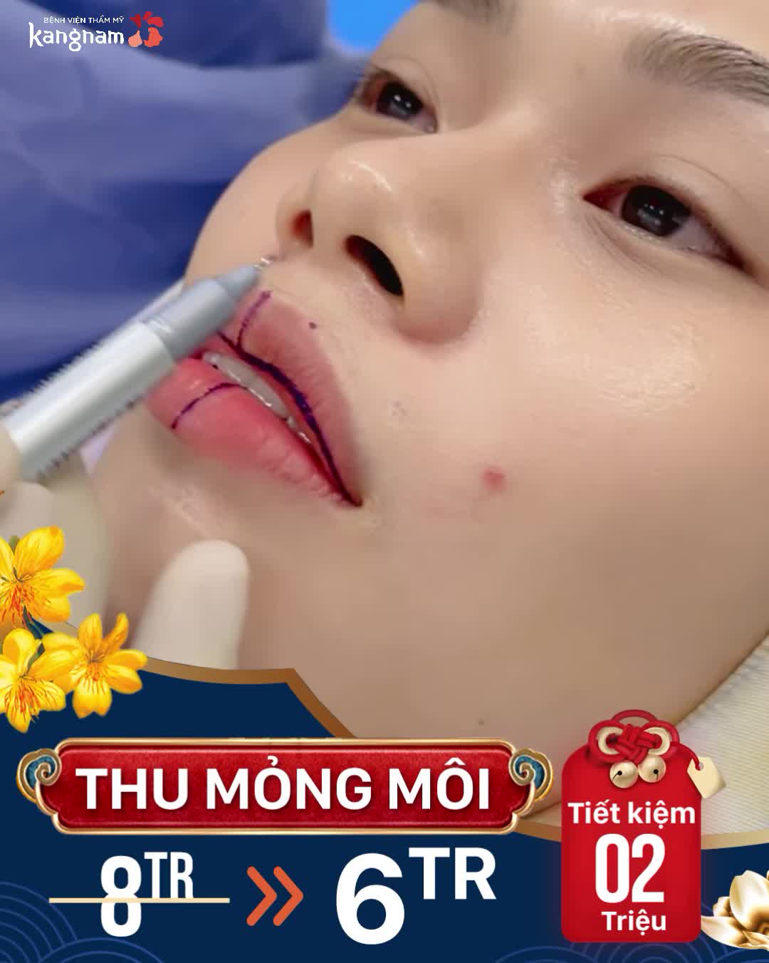 Tạm biệt môi dày chỉ với 30p Thu mỏng môi