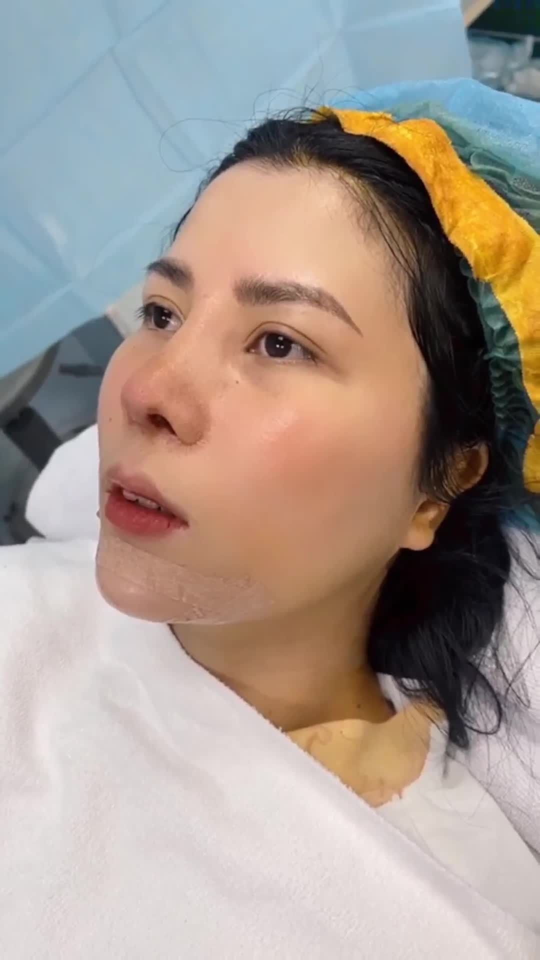 Chị khách hàng sau khi thực hiện nâng mũi sụn sườn 8 ngày quay lại trung tâm tiếp tục thực hiện độn cằm