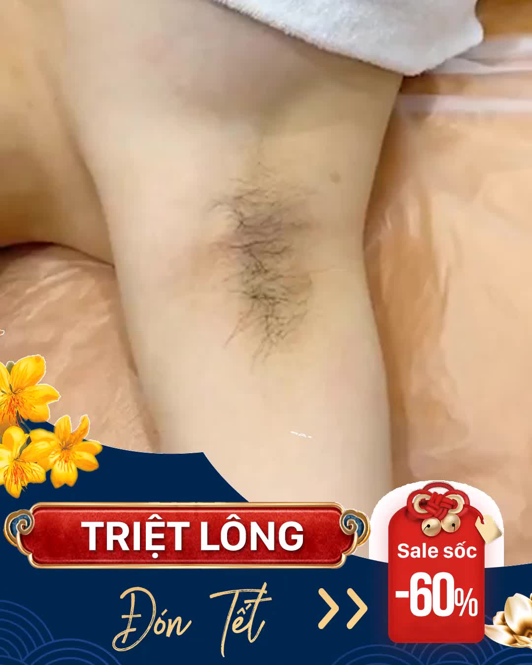 Triệt lông đón Tết - Dịch vụ HOT nhất thời điểm hiện tại