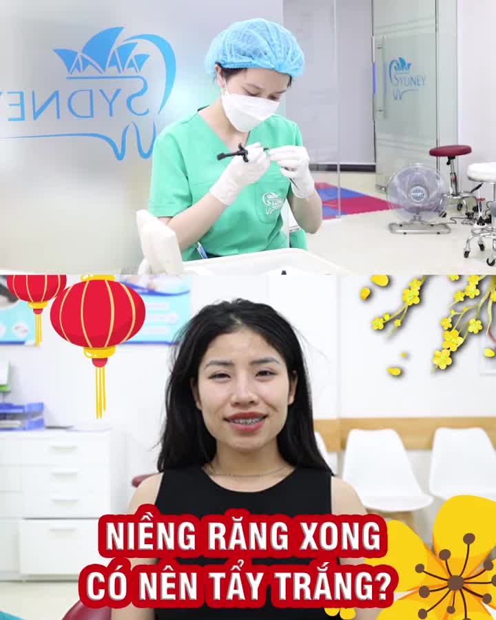 Niềng răng xong có nên tẩy trắng?