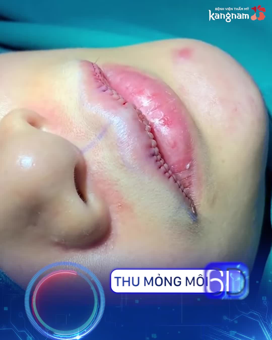 Đẹp Đẹp nữa với các dịch vụ Tạo hình môi ??