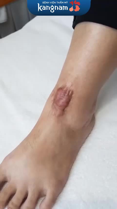 Tai nạn hình thành sẹo lồi trên cơ thể