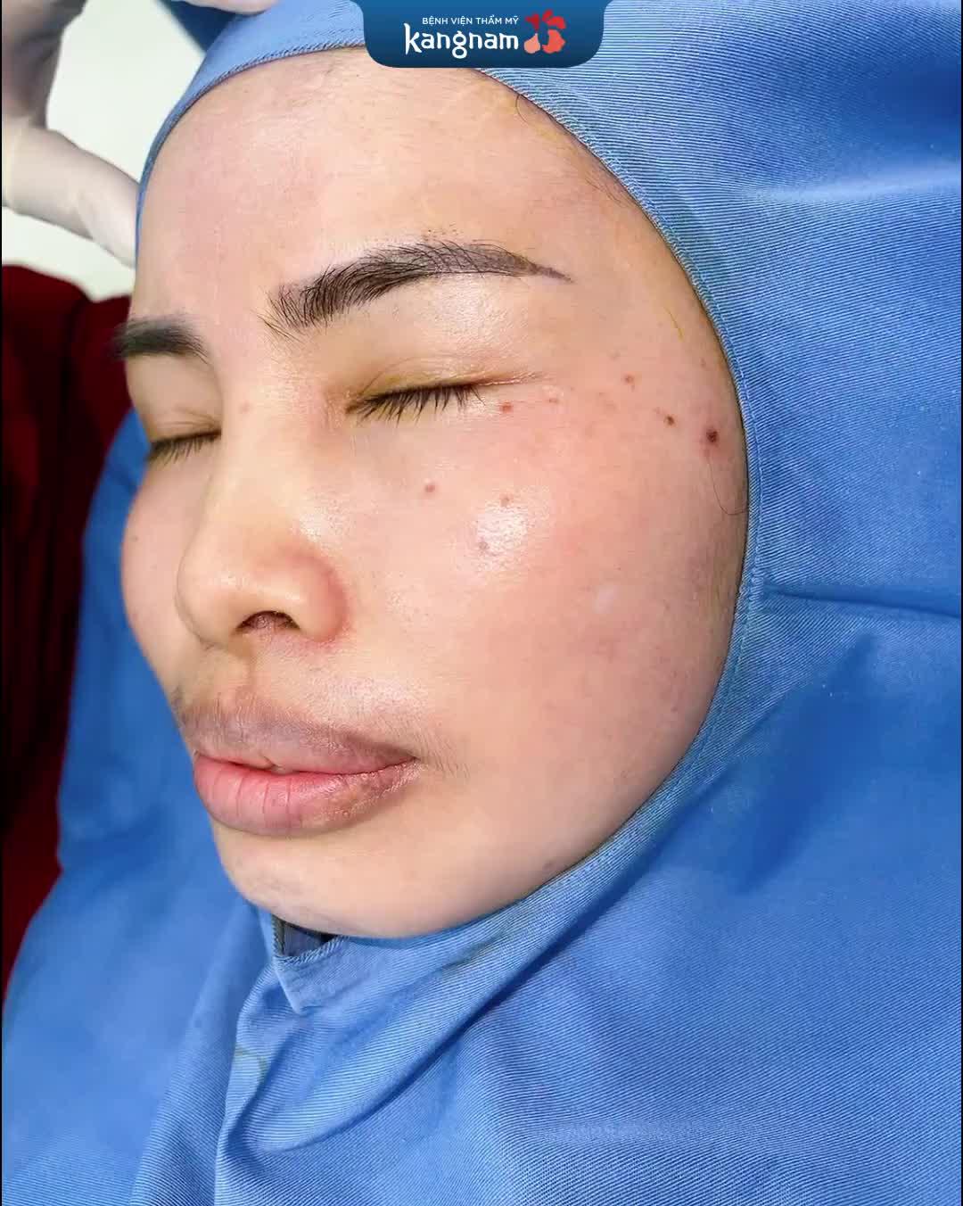 Cắt môi tim trên cho khách hàng có môi trên dày và thẳng