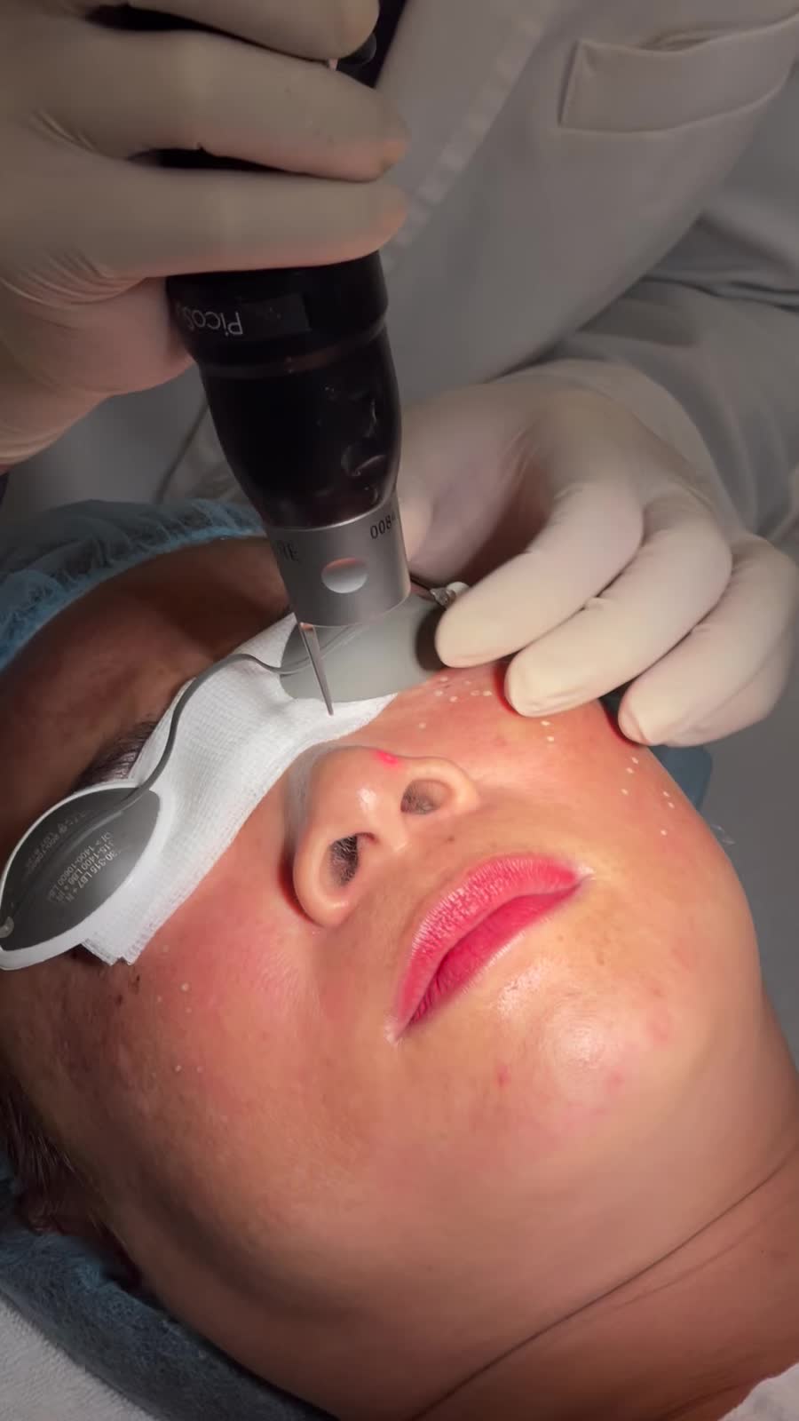 Nhìn nốt Tàn nhang bị phá vỡ bởi Laser Picosure mà mừng ghê!!!