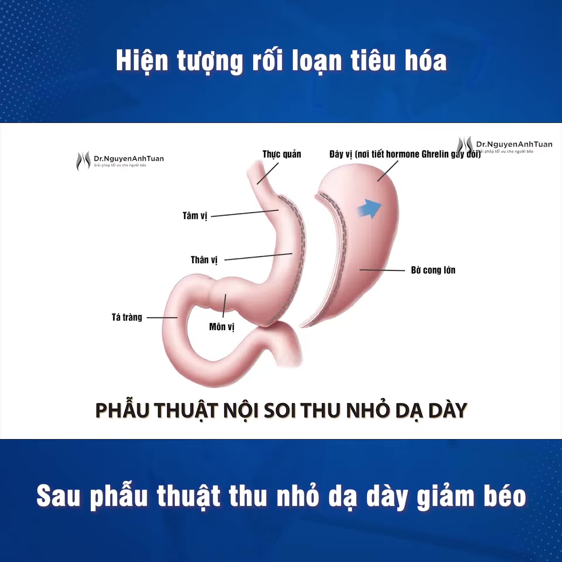 Vì sao lại có hiện tượng rối loạn tiêu hóa sau phẫu thuật thu nhỏ dạ dày giảm béo và cách khắc phục?