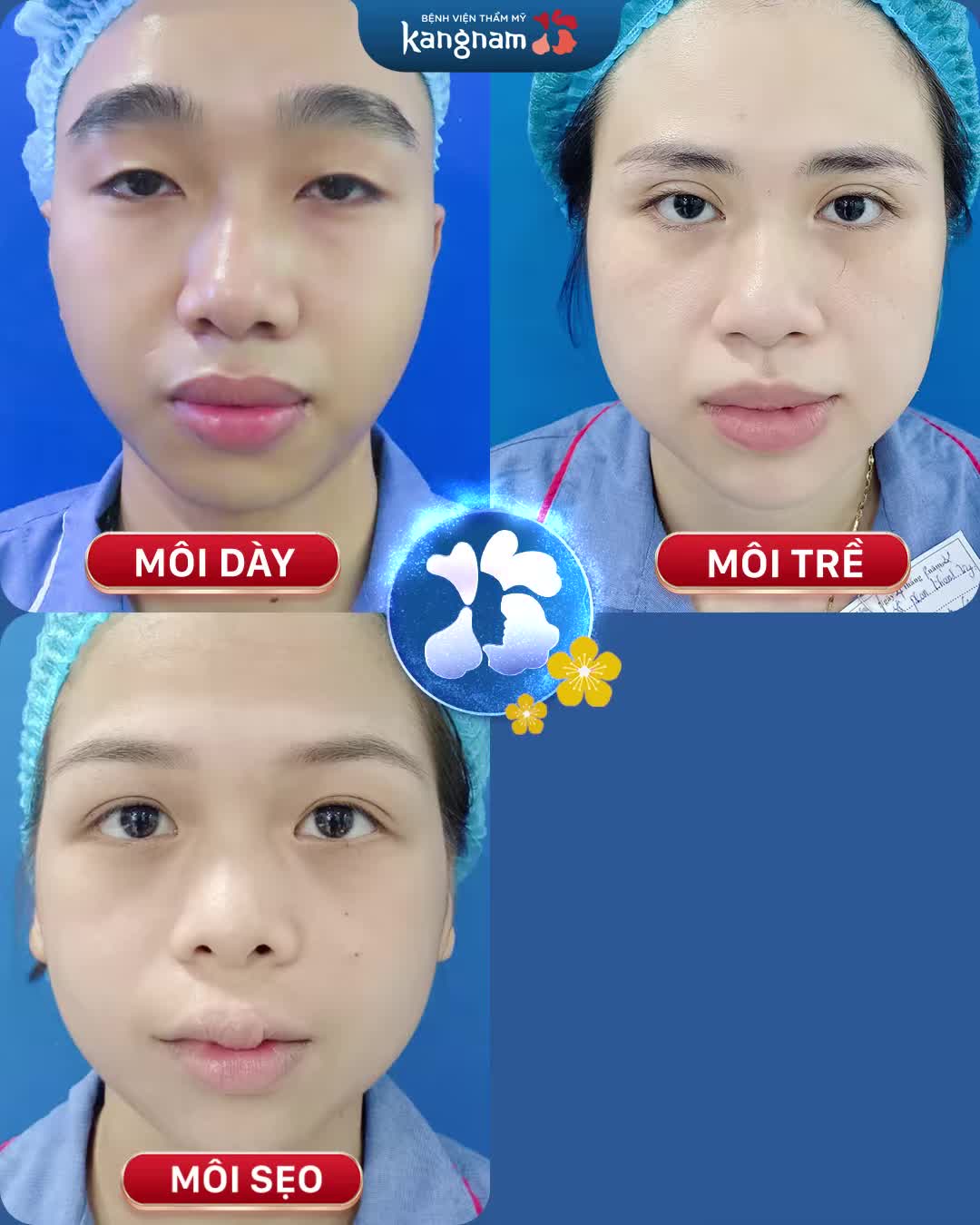 Thu mỏng môi -Tạo môi tim -Sửa sẹo môi