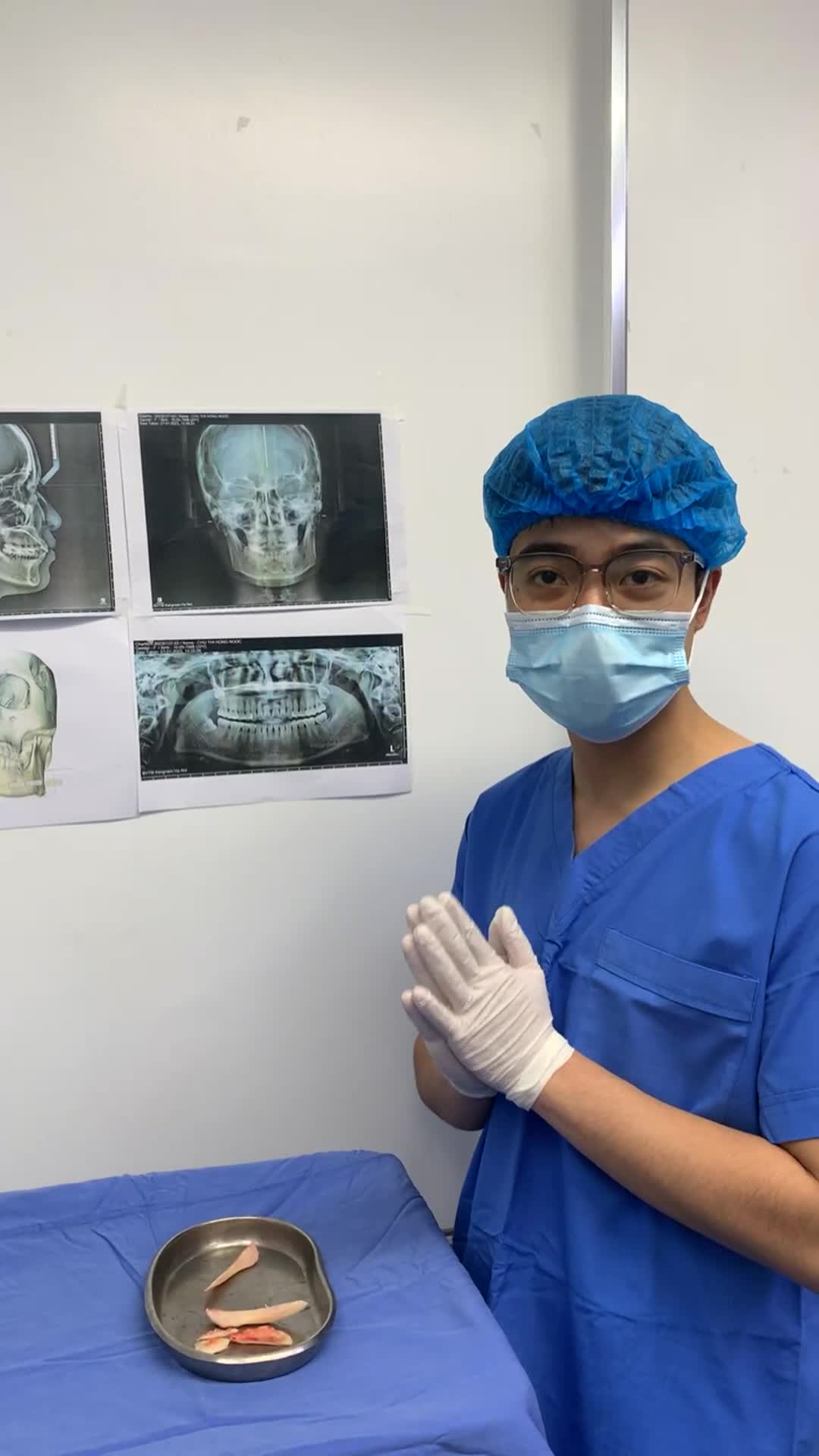 Cận cảnh xương góc hàm to bạnh sau 60 phút tại Chuyên khoa Chỉnh hình hàm mặt Kangnam