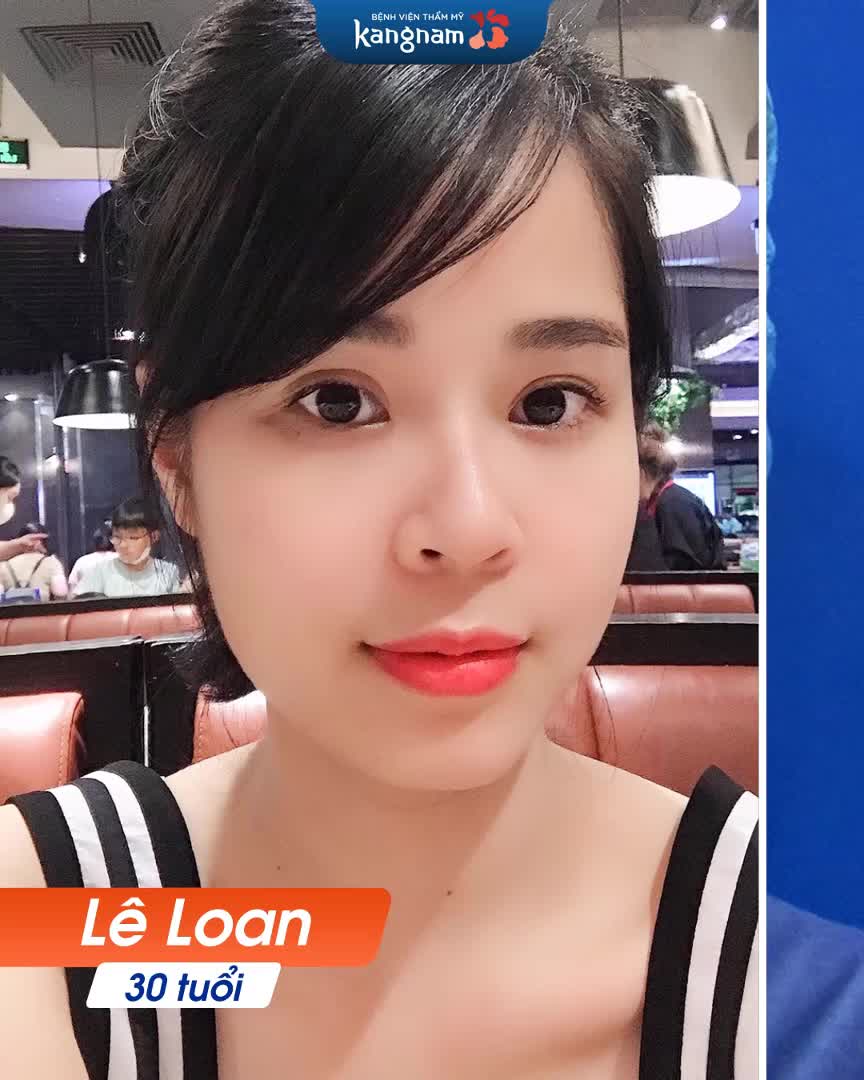 Top 3 siêu phẩm case khách hàng sau cấy mỡ