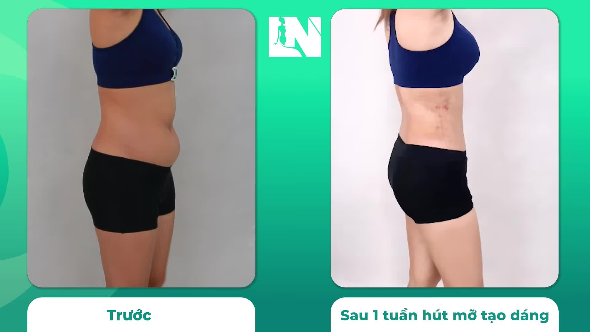 Thực hiện hút mỡ tạo dáng thẩm mỹ để chạm tay vòng eo thắt đáy - với Chị H.N (28 tuổi), mục đích không đơn thuần như thế: